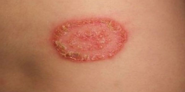 Otto casi di tigna in una famiglia. Comune e Asl si attivano