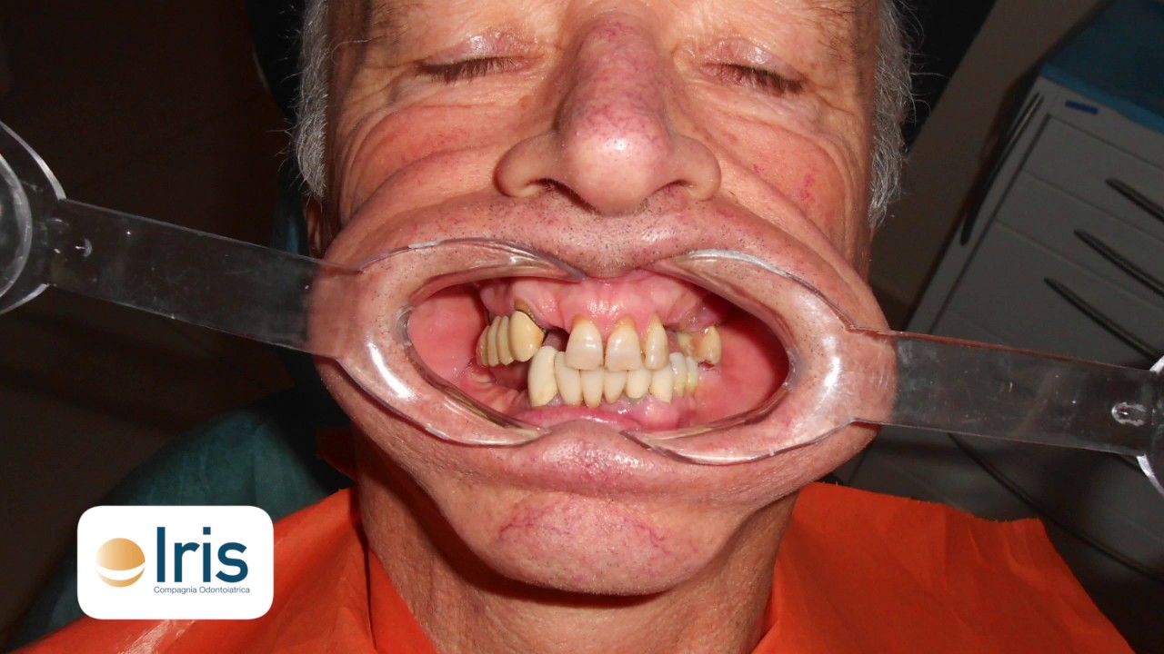 Gengivite e parodontite: trascurarle è sempre un errore